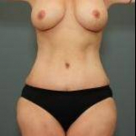 ABDOMINOPLASTY POST MASSIVE WEIGHT LOSS: Case 43 After